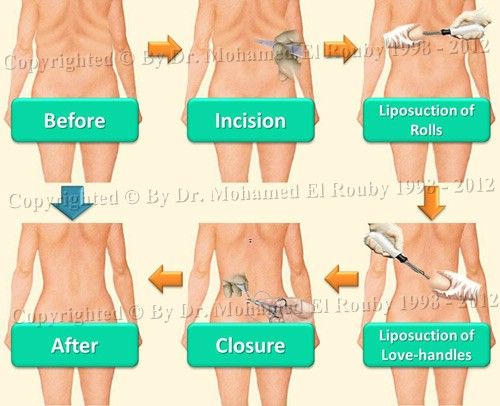 liposuction of the back liposuction of the back