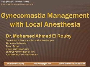 gynecomastia with local anaethesia
