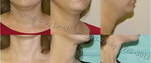 neck rejuvenation neck rejuvenation