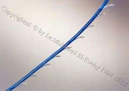 Contorno Threadlift™ Contorno Threadlift™