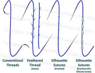 Threadlift Threadlift