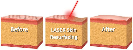 effect of laser on the skin effect of laser on the skin