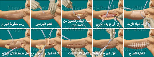خطوات شد الذراعين خطوات شد الذراعين