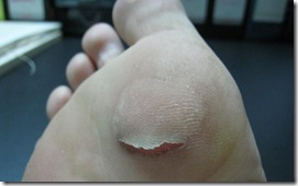 blister1