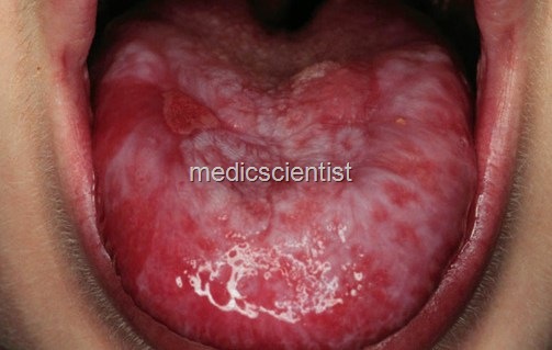 [aplastic anaemia 2[2].jpg]