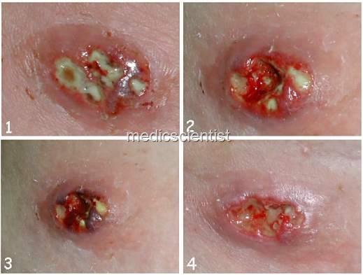 [STAPHYLOCOCCAL INFECTIONS[8].jpg]