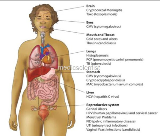 HIV IN WOMEN