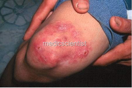Leprosy Hansen's Disease types Causes of leprosy sign and Symptoms ... Leprosy Hansen's Disease types Causes of leprosy sign and Symptoms ...