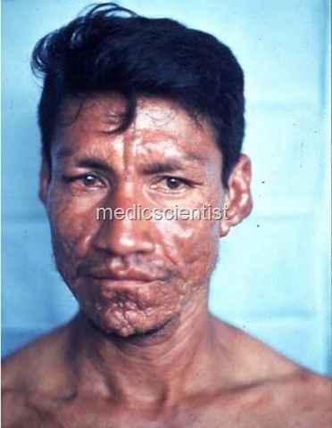 [Leprosy t[2].jpg]