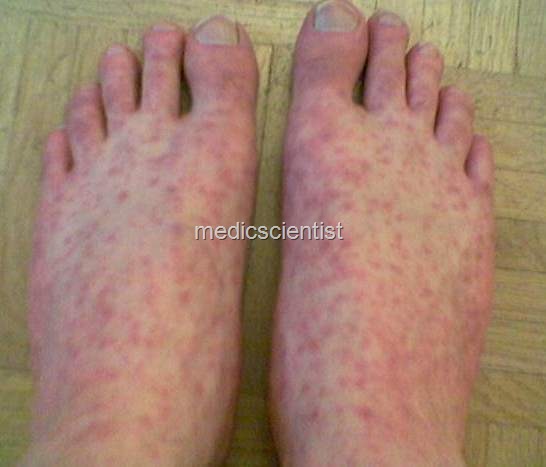 [ROCKY MOUNTAIN SPOTTED FEVER 1[2].jpg]
