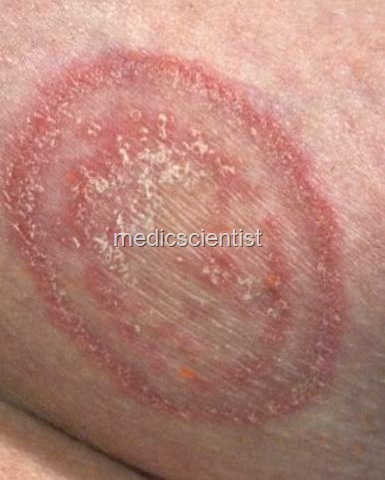 [Fungal Infections K[2].jpg]