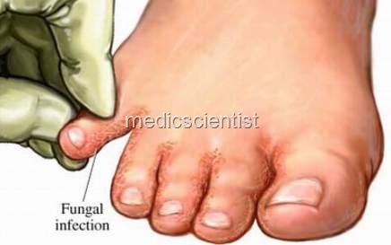 [Fungal Infections UI[2].jpg]
