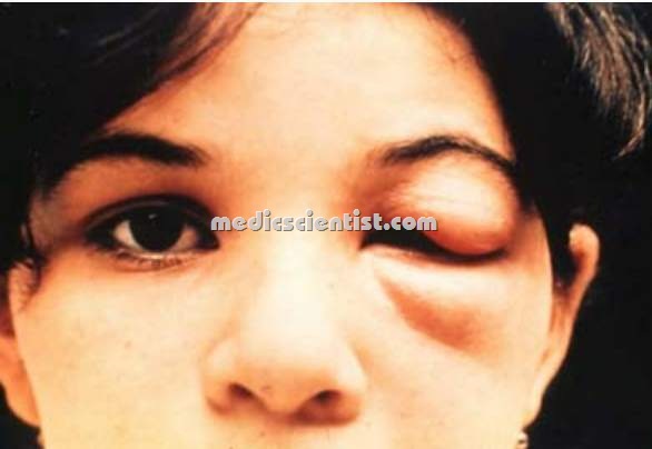 [Chagas' disease 2[2].jpg]