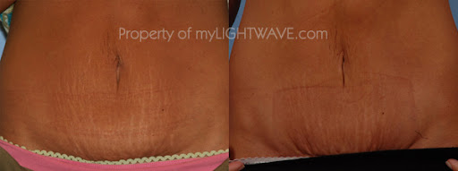 Actually, you don't have to be a celebrity to get stretch marks removed or 