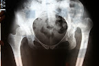 This woman presented with hip pain. Dr. Anita sent her for an xray, which showed this. When she showed the patient, the patient said, yeah, I've had that all my life! Apparently something was lost in translation.