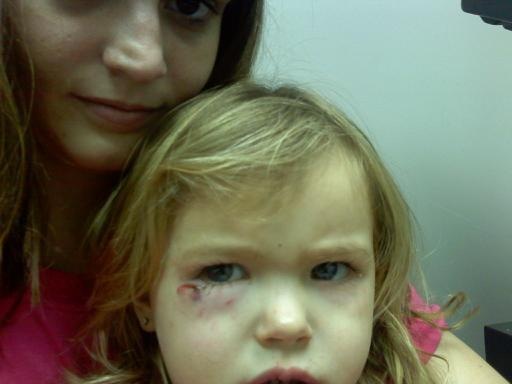[Dog Bite Before Stitches[3].jpg]
