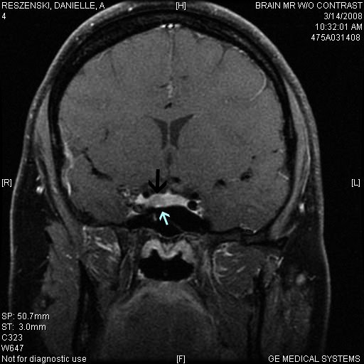 My Pituitary MRI from March, 2008