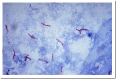 800px-Mycobacterium_tuberculosis_Ziehl-Neelsen_stain_02