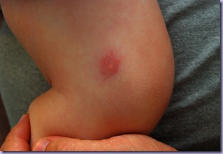 spiderbite2
