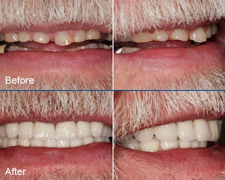 Art of Smiles Full-mouth Rehabilitation 