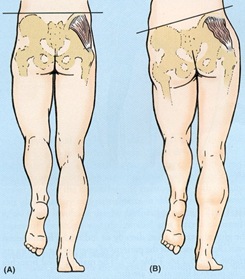 weak gluteus medius weak gluteus medius