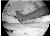 microfracture picking