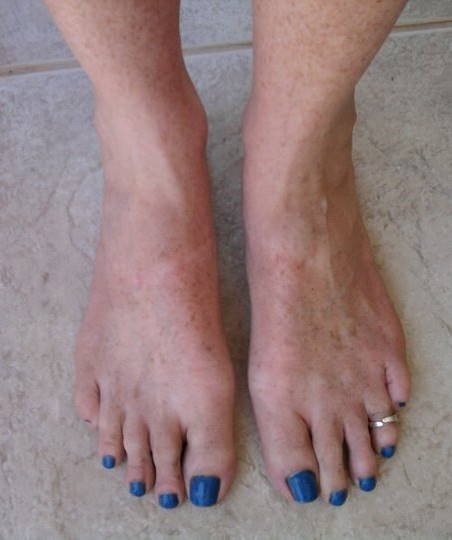 [Sunburnt feet resize[3].jpg]