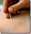 acupuntura acupuntura