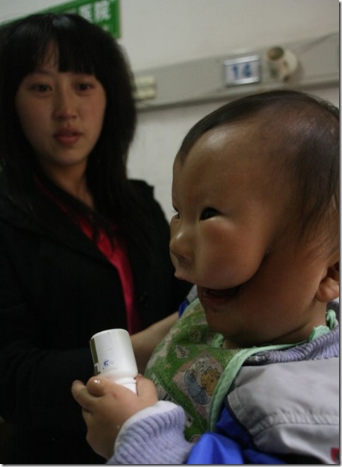 Transverse facial cleft  Boy Photo 3