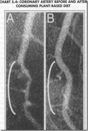 artery before and after plant-based diet