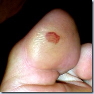 Blood Blisters 9782a