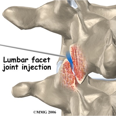 [pm_general_fji_lumbar[1][2].jpg]