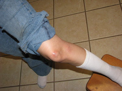Scraped Knee