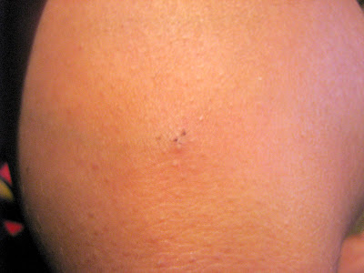 Spider bite is healing well
