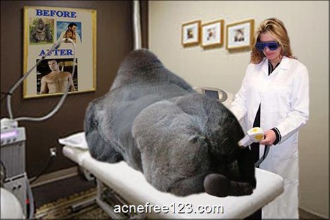 laser_hair_removal