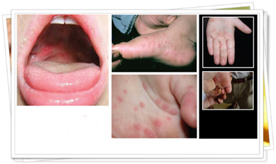 Hand-Foot-and-Mouth-Disease