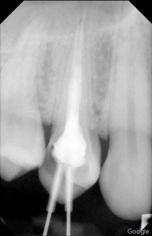 [root canal[6].jpg]