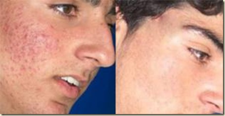 acne3 acne3