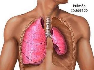 [Cancer Pulmonar II[1].jpg]