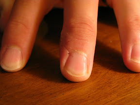 Day 12.  Stitches removed!!   Here you can see, if you look closely, where the blade actually cut into the nail.  I think it's just a surface scratch though, or I would imagine a lot more bloody discoloration under the nail.