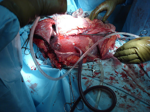 Трансплантация...