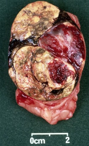[cushings-adrenal-adenoma[2].jpg]