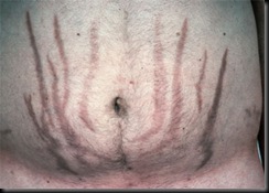 Purple Striae