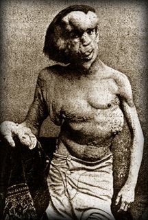 el hombre elefante