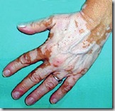 j61-001-vitiligo j61-001-vitiligo