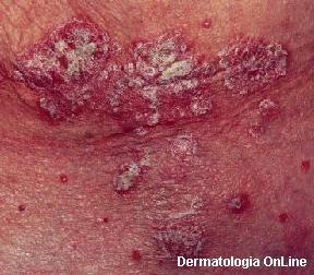 [psoriase-1[7].jpg]