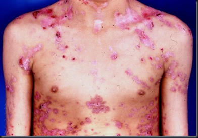 epiderm_bolhosa_13 epiderm_bolhosa_13