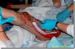Helena.MRSA-3.400 Helena.MRSA-3.400