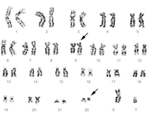 Karyotype from a 33-year-old male presenting with chronic myelogenous leukemia (CML). 46,XY,t(9;22)(q34;q11.2). See text for details about this translocation. The derivative chromosomes 9 and 22 are marked by arrows 