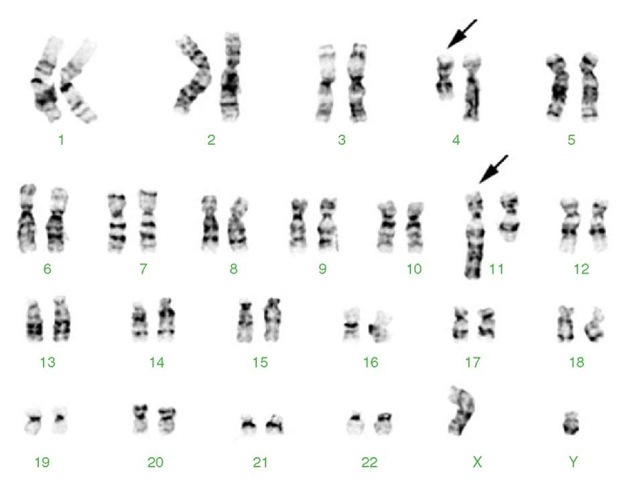  Karyotype from a young boy with acute lymphoblastic leukemia. This translocation results in fusion of the MLL gene at 11q23 and the MLL2/AF4 gene at 4q21, resulting in an abnormal chimeric transcript. The leukemia in these patients usually has aggressive clinical features, hyperleukocytosis, a B-precursor immunophenotype with coexpression of myeloid markers, and a poor response to conventional chemotherapy. 46,XY,t(4;11)(q21;q23). The derivative chromosomes 4 and 11 are marked by arrows 